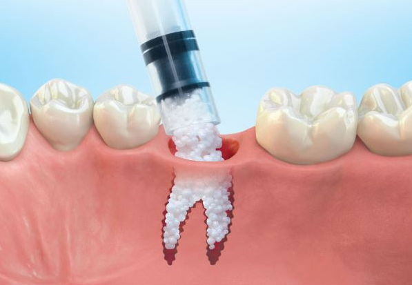 Dental Bone Grafting Raleigh NC