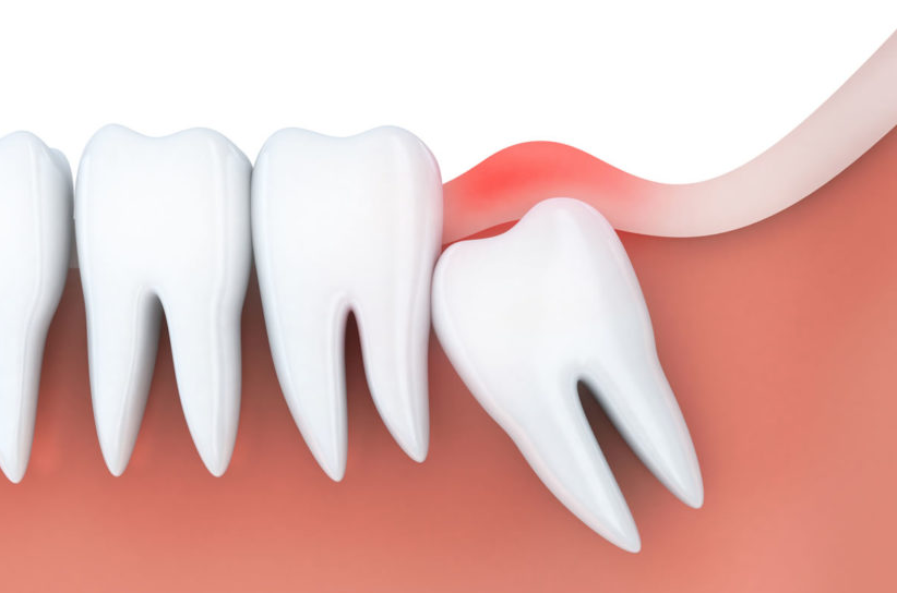 wisdom teeth extraction in Raleigh NC